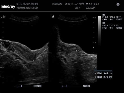 Bicornuate Uterus Radiology Reference Article