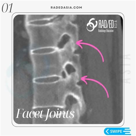 Ankylosing Spondylitis Spine Radiology Ct Mri Fusion Images Radedasia