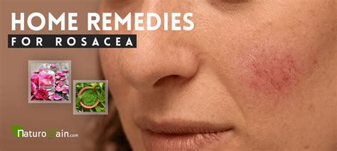 9 Best Home Remedies For Rosacea That Give Fast Relief
