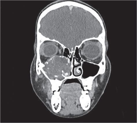 Immature Teratoma Of The Maxillary Sinus A Rare Pediatric Tumor