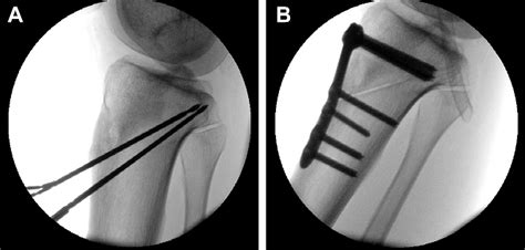 Figure 1 From Effect Of Anterior Tibial Closing Wedge Osteotomy On