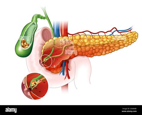 Ilustración que muestra el páncreas inflamado cálculos biliares que