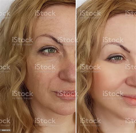 Woman Face Wrinkles Before And After Stock Photo Download Image Now