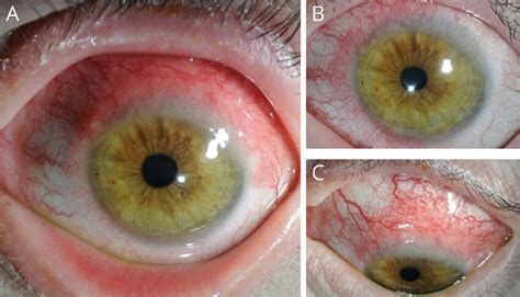 Appearance Of Limbal Inflammation In Patients With Dupilumab Associated