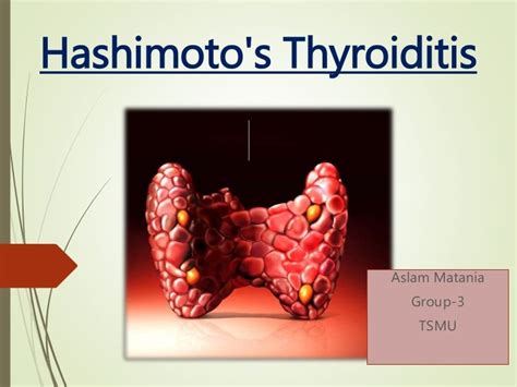 Hashimotos Thyroiditis By Aslammatania