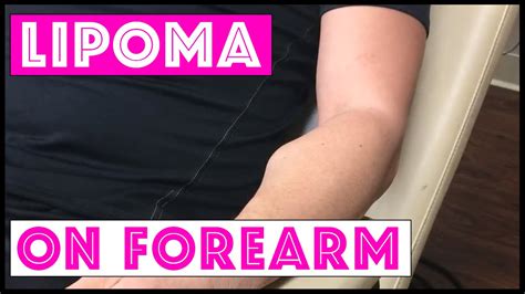 Excision Of Large Lipoma On Forearm Youtube