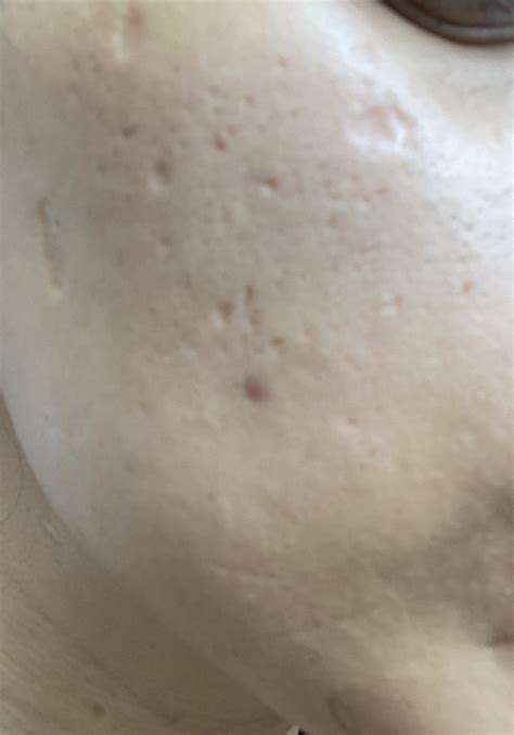 Atrophic Scars Caused By Chicken Pox Other Acne Treatments