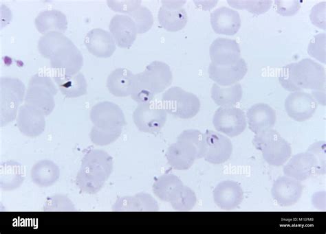 Plasmodium Falciparum Blood Smear