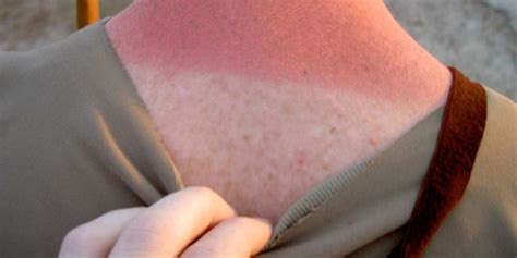 It can cause reddening, inflammation, and in extreme cases, blistering and peeling. Anatomy of a Sunburn - A Timeline of Dermatological ...