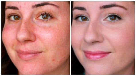 How To Cover Redness Natural Remedies For Rosacea Rosacea Skin Care