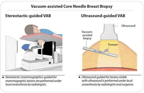 Breast Cancer Symptoms Treatments Singhealth