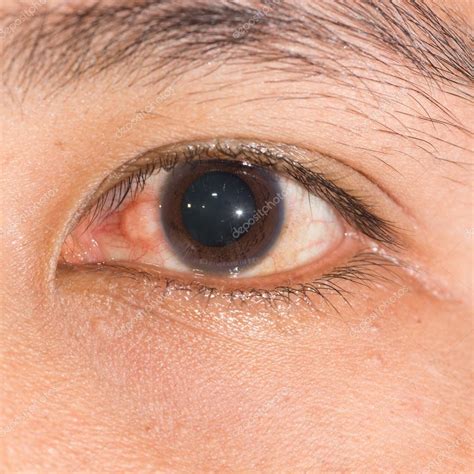 Nodular Episcleritis At Eye Test — Stock Photo © Arztsamui 105260550