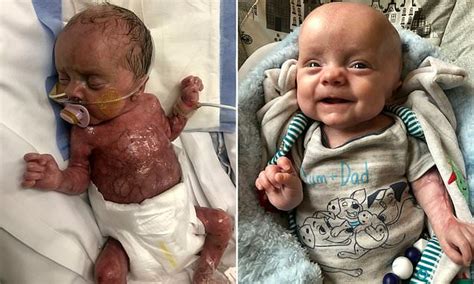 Miracle Baby Kaiden Jake Shattock Was Born Without Skin And Defies The
