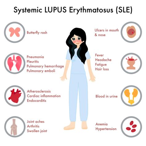 Systemic Lupus Erythematosus Sle Medic Drive