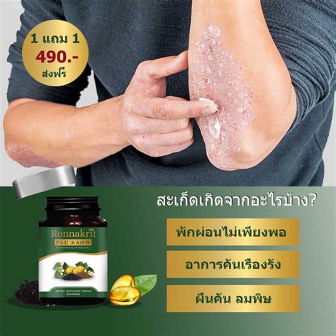 2 Bottles Of Pro Plu Kao Fungus Itching Hives Psoriasis Eczema Skin