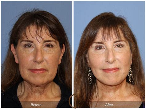 Facelift Fifties Before And After Photos Patient 73 Dr Kevin Sadati
