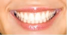 Veneers Dentist In North Syracuse NY Gregory Sweeney DDS