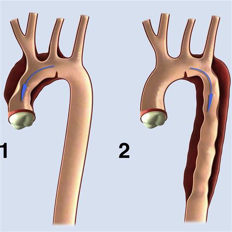 Acute Aortic Dissections With Entry Tear In The Arch A Report From The