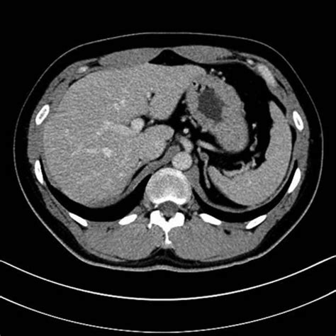 Ct Scan Showing Left Adrenal Gland Hyperplasia And Nodular Protrusions