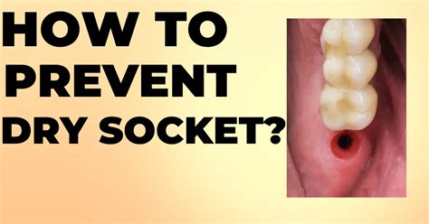 how to prevent dry socket from tooth extraction