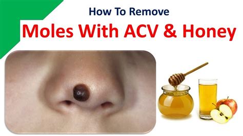 How To Remove Moles With Apple Cider Vinegar And Honey Youtube