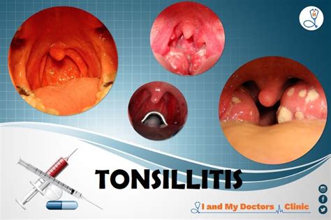 Tonsils Are The Two Lymph Nodes Located On Each Side Of The Back Of
