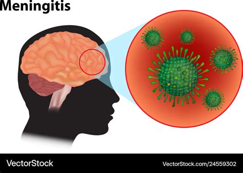 Viral Meningitis And Encephalitis Royalty Free Vector Image