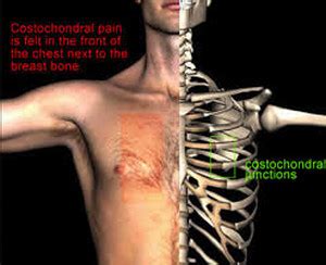 Contrary to a widely held misconception, men and women have the same number of ribs. Pain under Right Rib Cage
