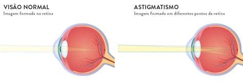 Graus de astigmatismo Como saber se é alto Lenscope