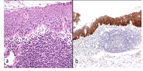 Figure 1 From Diagnostic Challenge Of Cervical Intraepithelial
