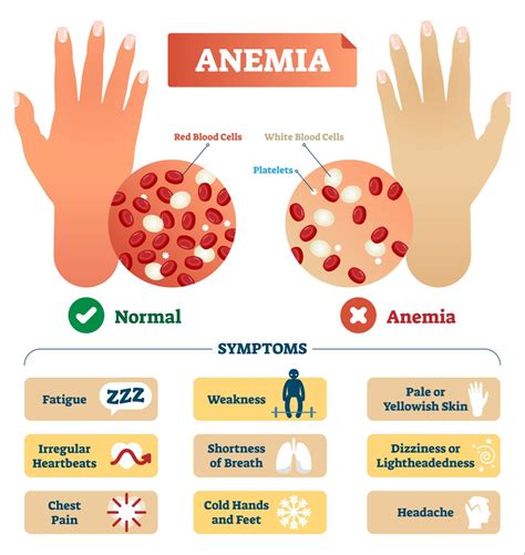 Anemia In Women Symptoms Stopbaca