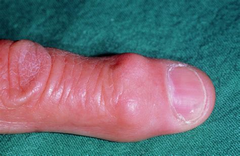 Heberden S Node On Finger In Osteoarthritis Photograph By Dr P Marazzi Science Photo Library