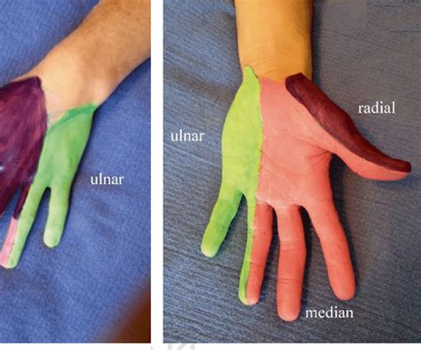 3 Dorsal Dermatomal Distribution Of Hand Innervation Image Courtesy Of