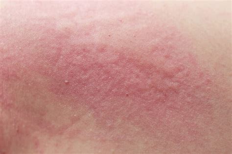 Cutaneous Candidiasis Causes Risk Factors Signs Symptoms Diagnosis And Treatment Scope Heal