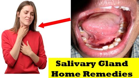 Salivary Glands Salivary Gland Infection Salivary Gland Infection
