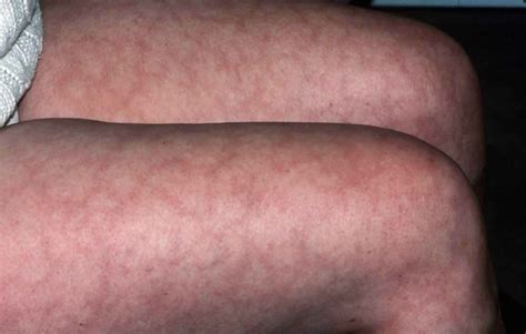 Mottled Skin Or Livedo Reticularis Causes Diagnosis And Treatment