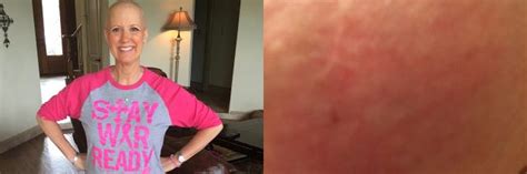 This Moms Chest Rash Turned Out To Be A Rare Breast Cancer