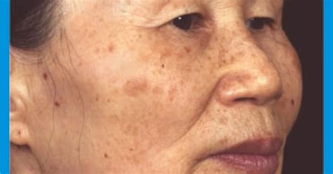 Skin Whitening Forever Types Of Brown Spots The Skin Problem