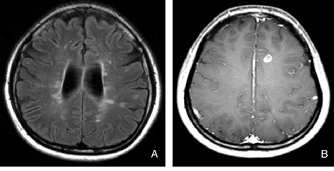 Representing Mri Of Multiple Sclerosis A Fluid Attenuated Inversion