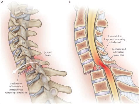 Multilevel Thoracic Spondylosis What Is Multilevel Spondylosis