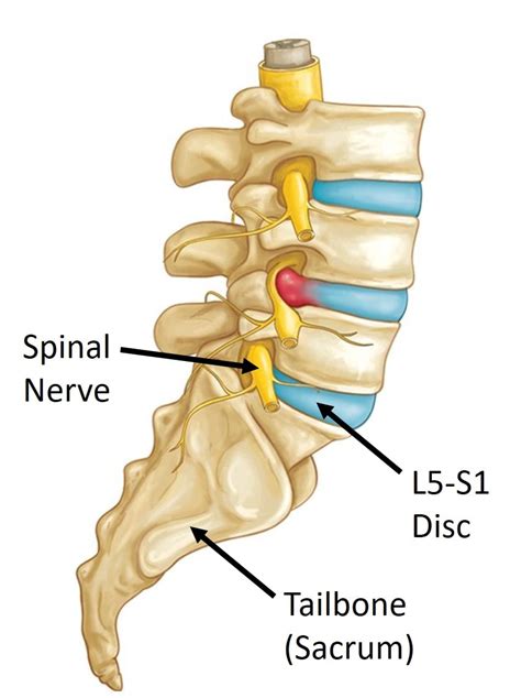 The back of the leg (calf). Problems with the L5-S1 Disc?