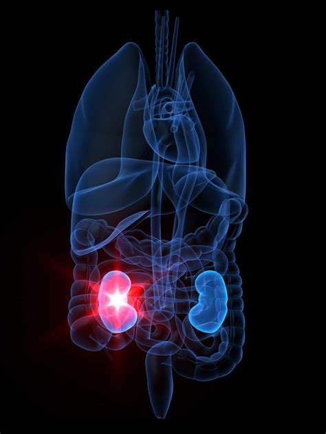 Follow These Top Warning Signs Indicating You May Have Kidney Stones
