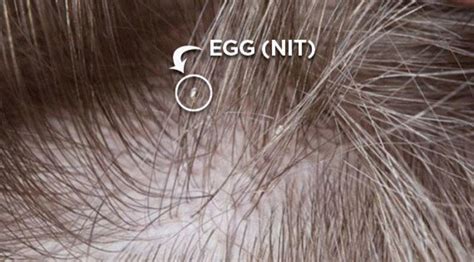 What Are Nits And What Do They Look Like The Lice Removal