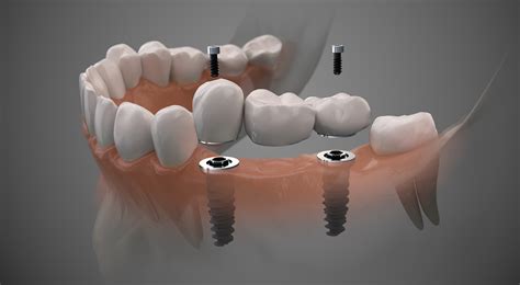 Single And Multiple Dental Implants Chaska Mn Tooth Replacement