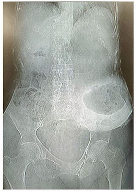 Stomach In A Parastomal Hernia A Rare Complication Of Stomas Bmj