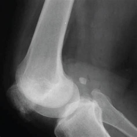 The Step Of Mpfl Reconstruction Including The Patellar Side Graft