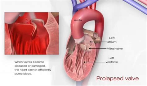 What Is Mitral Valve Prolapse Cardiology Specialist Houston Arsalan Shahzad Md Facc