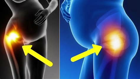 5 Facts To Know About Hip Pain And Pregnancy Youtube