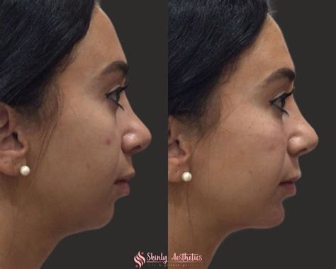 Chin Fillers Before And After Results At Skinly