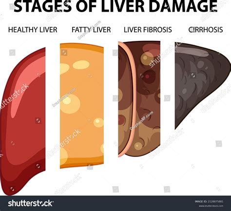 Diagram Showing Stages Liver Damage Illustration Stock Vector Royalty